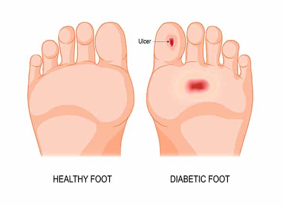 Diabetic Foot Care Calgary - Achilles Foot Clinic