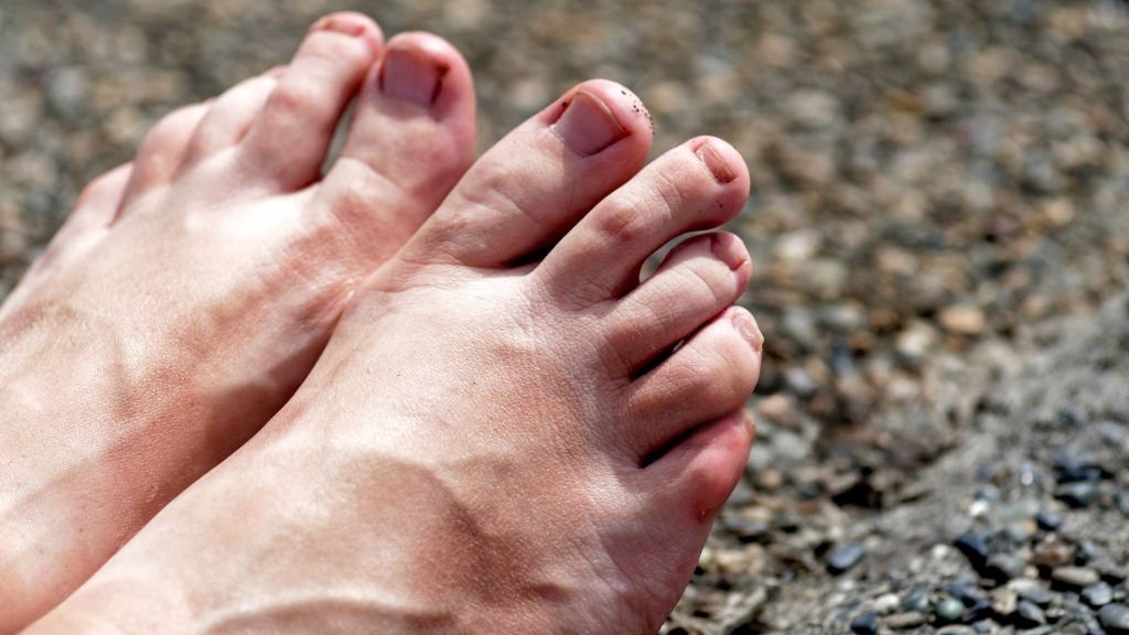Hammertoes Treatment - Achilles Foot Clinic