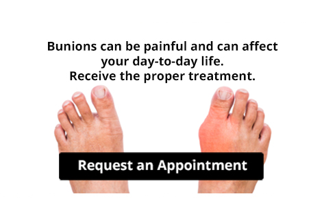 Bunion - Achilles Foot Clinic