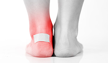 Blister - Achilles Foot Clinic