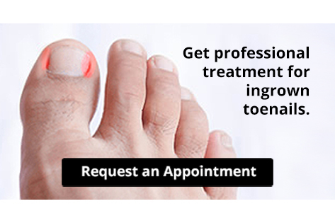 Ingrown Toenails - Achilles Foot Clinic