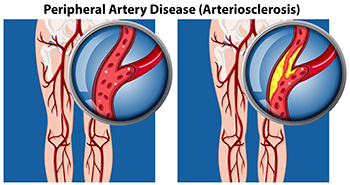 
Peripheral artery - Achilles Foot Clinic