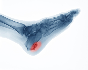 Heel Spurs - Achilles Foot Clinic