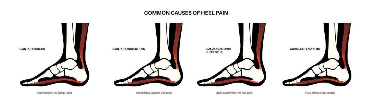 Heel Pain: 5 Common Causes: Phoenix Foot and Ankle Institute: Foot and Ankle  Specialists