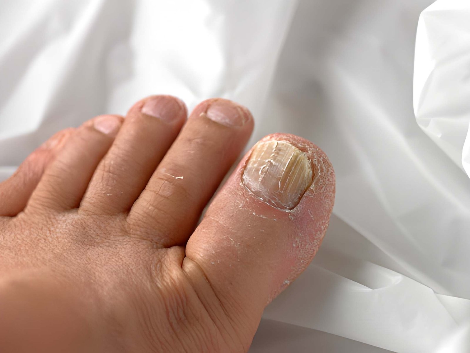Fungal Toenails - Achilles Foot Clinic