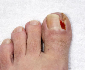 Ingrown Toenails Treatment in Calgary, AB