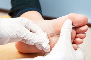 Doctor treating plantar warts