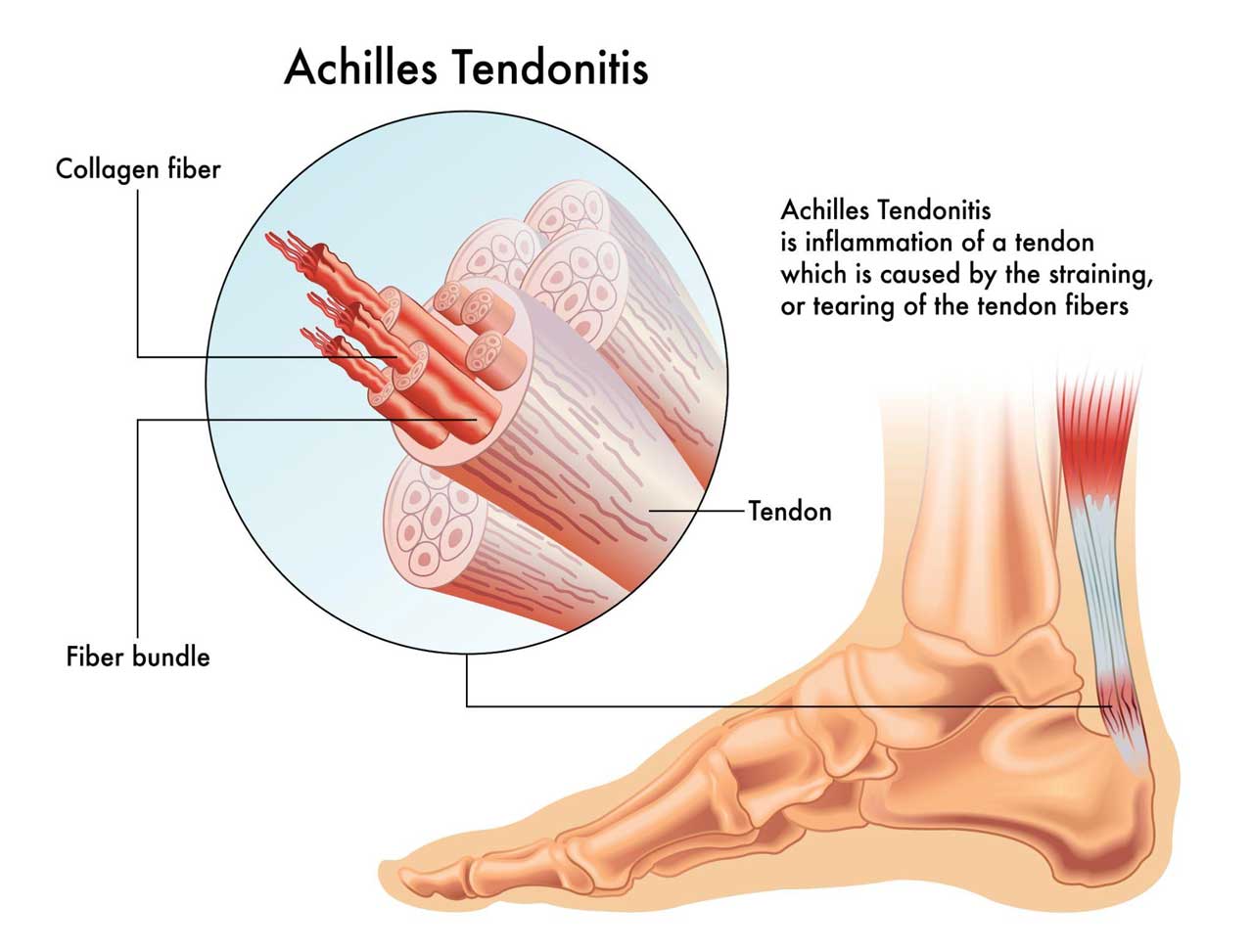 achilles tendon