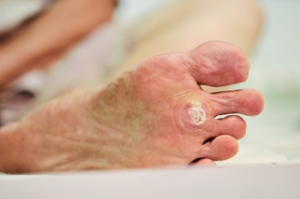 Are Plantar Warts Contagious?