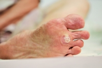 Are Plantar Warts Contagious?