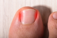 Do I Have an Ingrown Toenail?