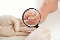 How Contagious Is Toenail Fungus?