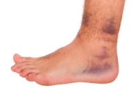How Do Ankle Sprains Occur?