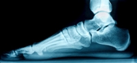 Can Flat Feet Cause Foot Pain?