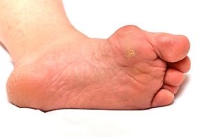 Bunions May Be a Bone Deformity